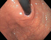 reflux_endoskopie_01