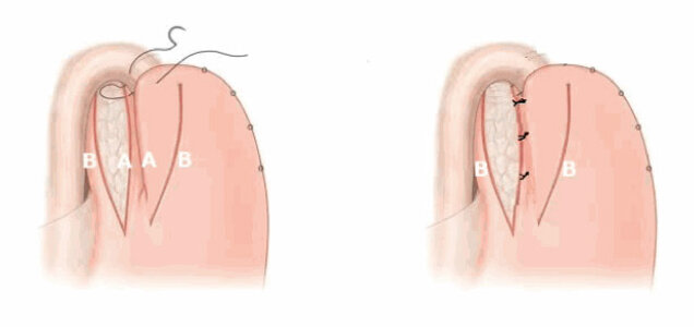 Fundolplikatio after Toupet (<a href="https://www.medscape.com/viewarticle/511771_4">source </a>) Dor fundoplication