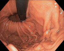 reflux_endoskopie_02